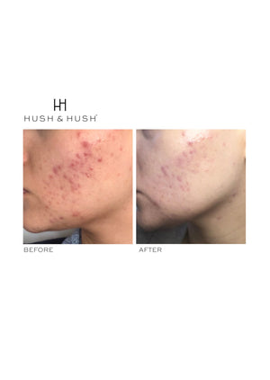 
            
                Load image into Gallery viewer, Hush &amp;amp; Hush SkinCapsule CLEAR+ | Skin Care Products | SkinJourney
            
        