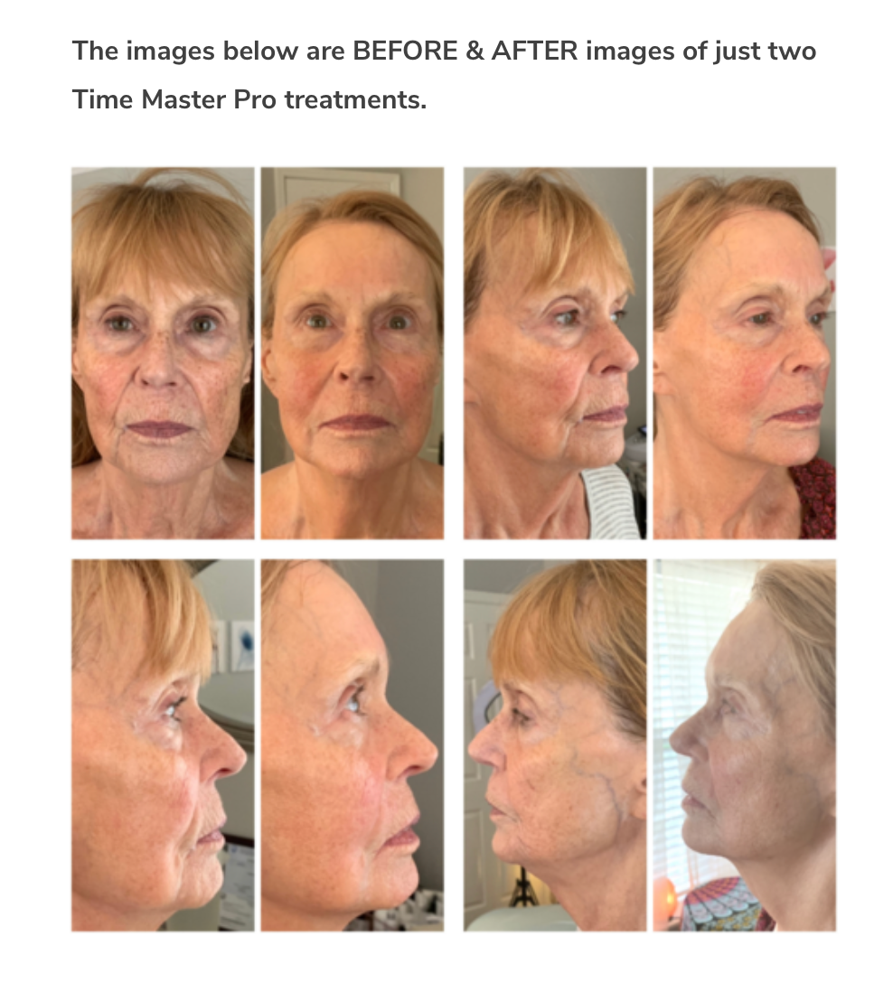 Load image into Gallery viewer, Time Master Pro with Sculplla Promoter Collagen Gel |  SkinJourney
